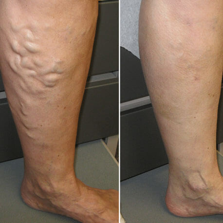 About Varicose Veins - We Cure Varicose Veins By Naturopathy Treatment